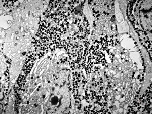 F, 57y. | acromegaly - acidophilic pituitary adenoma (STH)